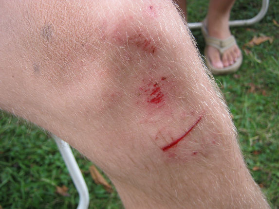 Davidovo koleno po pádu v závěrečném sjezdu Moravského Bikemaratonu v Leštině 28.8.2011